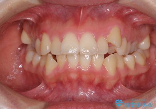 狭い歯列を拡大　拡大装置を併用したインビザライン矯正の症例 治療前