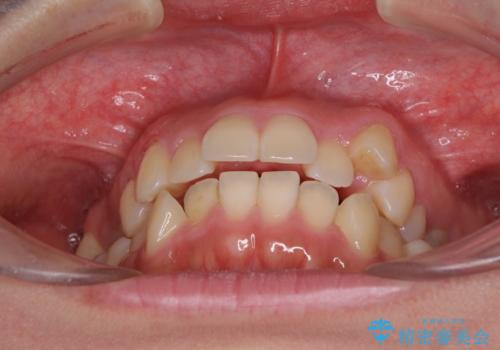 狭い歯列を拡大　拡大装置を併用したインビザライン矯正の治療前