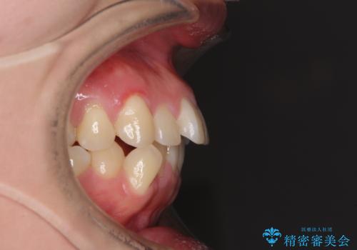 狭い歯列を拡大 拡大装置を併用したインビザライン矯正の治療前