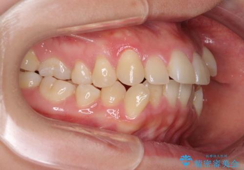 狭い歯列を拡大 拡大装置を併用したインビザライン矯正の治療前