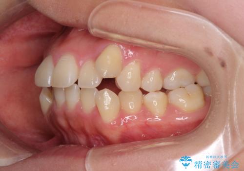 狭い歯列を拡大 拡大装置を併用したインビザライン矯正の治療前
