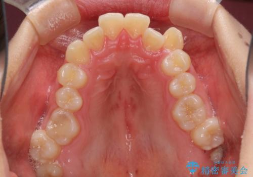 狭い歯列を拡大　拡大装置を併用したインビザライン矯正の治療前