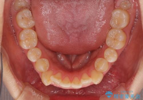 狭い歯列を拡大 拡大装置を併用したインビザライン矯正の治療前