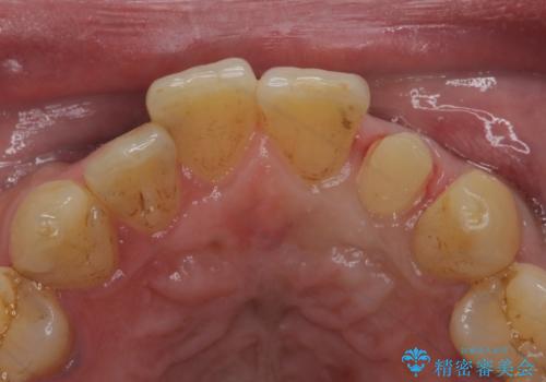 前歯のセラミック治療の治療中