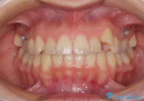 狭い歯列を拡大 拡大装置を併用したインビザライン矯正の治療中