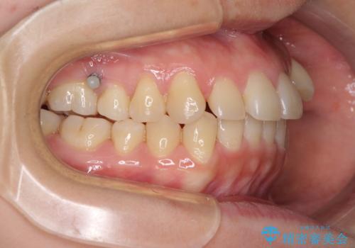 狭い歯列を拡大 拡大装置を併用したインビザライン矯正の治療中