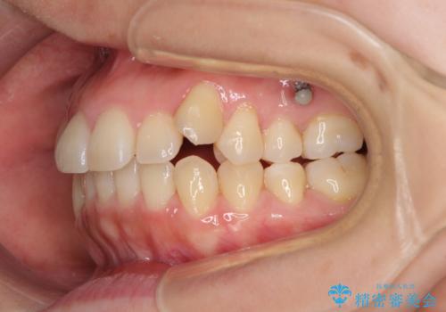 狭い歯列を拡大 拡大装置を併用したインビザライン矯正の治療中