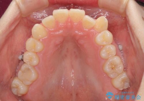 狭い歯列を拡大　拡大装置を併用したインビザライン矯正の治療中