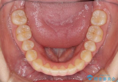 狭い歯列を拡大 拡大装置を併用したインビザライン矯正の治療中