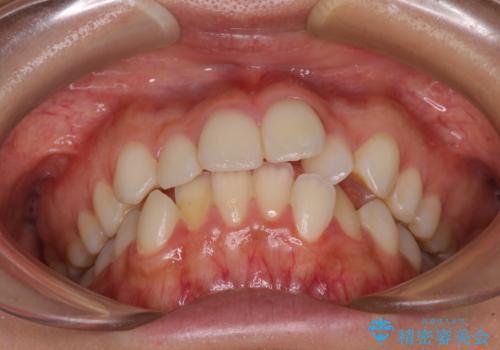 【モニター】前歯のクロスバイトをインビザラインで治療の治療前