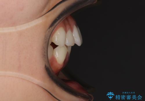 【モニター】前歯のクロスバイトをインビザラインで治療の治療前