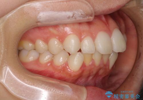 【モニター】前歯のクロスバイトをインビザラインで治療の治療前