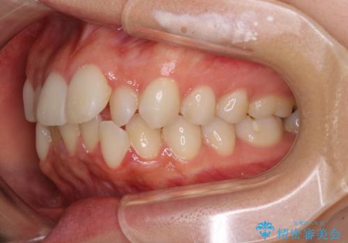 【モニター】前歯のクロスバイトをインビザラインで治療の治療前