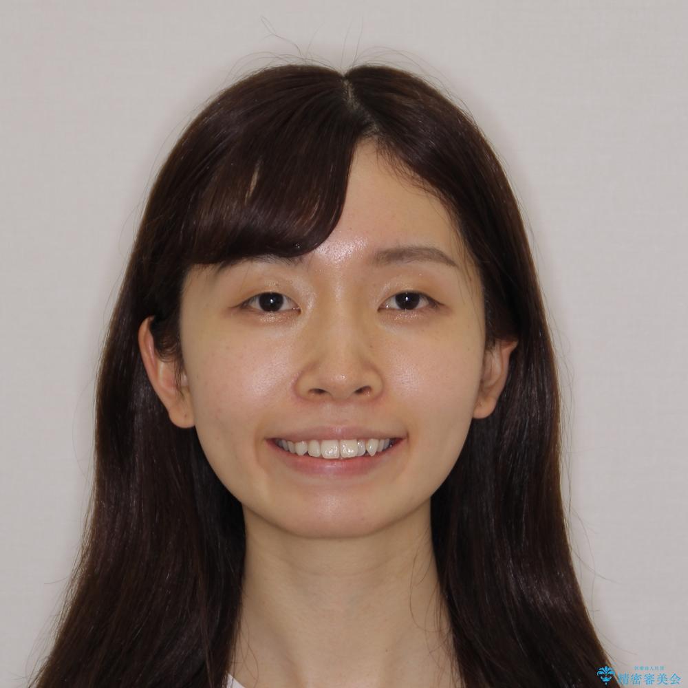 【モニター】前歯のクロスバイトをインビザラインで治療の治療前(顔貌)