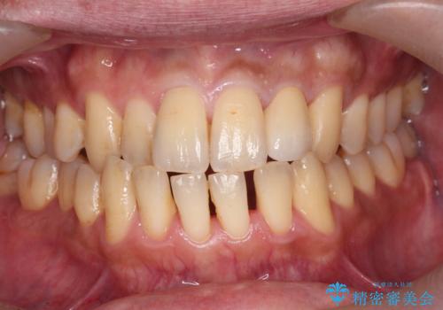 前歯のセラミック治療の症例 治療後