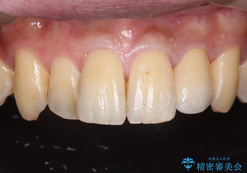 前歯のセラミック治療の治療後