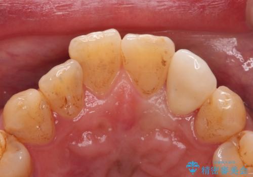 前歯のセラミック治療の治療後