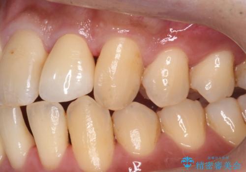 前歯のセラミック治療の治療後