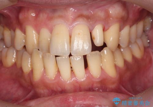 前歯のセラミック治療の治療中