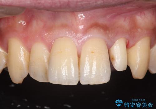 前歯のセラミック治療の治療中