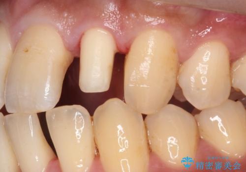 前歯のセラミック治療の治療中