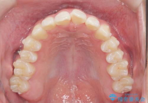 [ 先天性の前歯欠損 ]  マウスピース矯正とインプラント治療の治療中