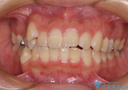 閉じにくい口元と八重歯　ワイヤー装置での抜歯矯正の治療前