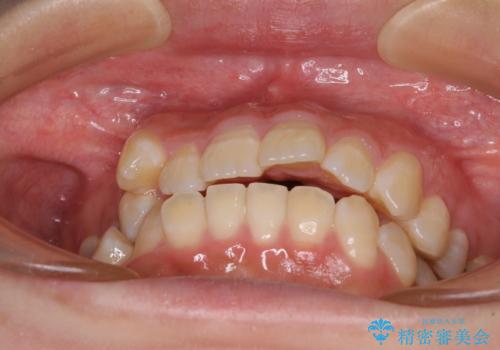 閉じにくい口元と八重歯　ワイヤー装置での抜歯矯正の治療前