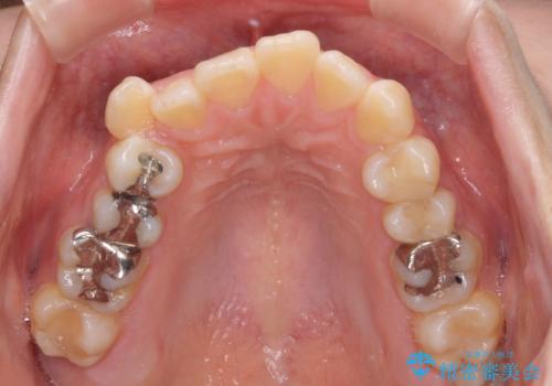 閉じにくい口元と八重歯 ワイヤー装置での抜歯矯正の治療前
