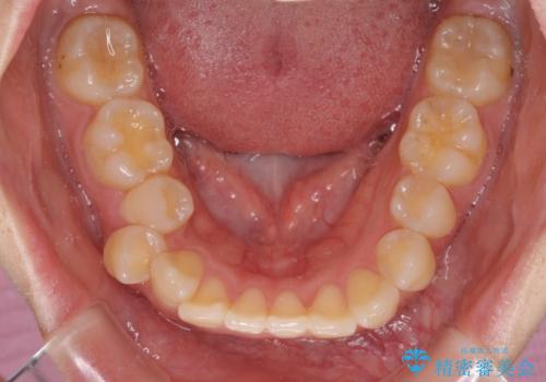 閉じにくい口元と八重歯 ワイヤー装置での抜歯矯正の治療前