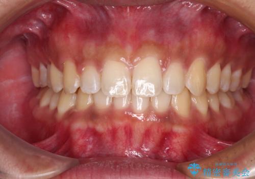 デコボコとディープバイトを治したい インビザラインによる矯正治療の治療中