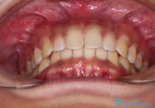 デコボコとディープバイトを治したい インビザラインによる矯正治療の治療中