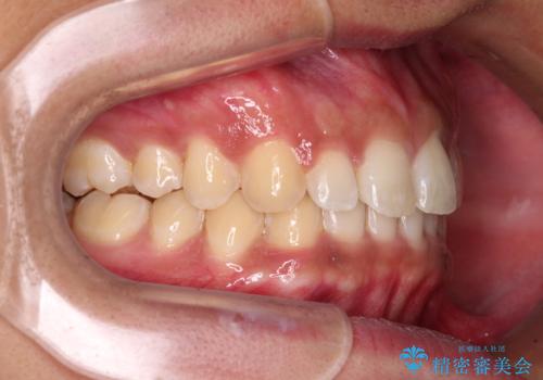 デコボコとディープバイトを治したい インビザラインによる矯正治療の治療中