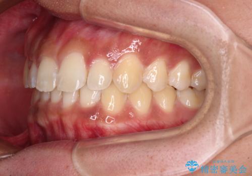 デコボコとディープバイトを治したい インビザラインによる矯正治療の治療中