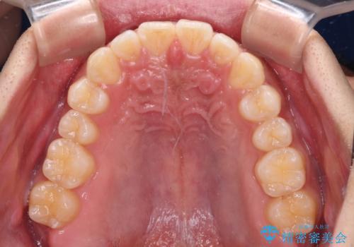 デコボコとディープバイトを治したい インビザラインによる矯正治療の治療中