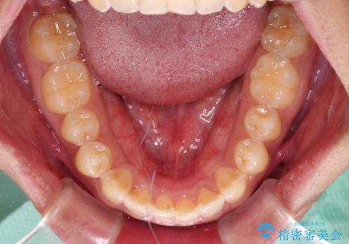 デコボコとディープバイトを治したい インビザラインによる矯正治療の治療中