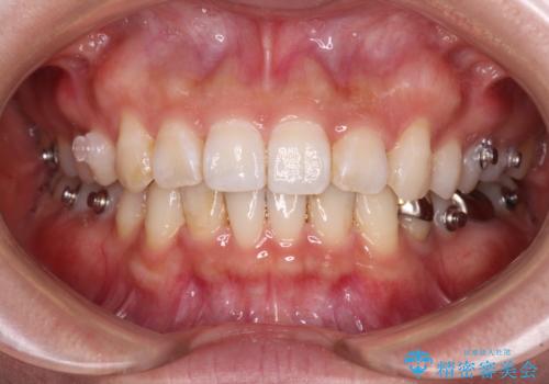 ディープバイトとデコボコを解消 インビザライン矯正の治療中