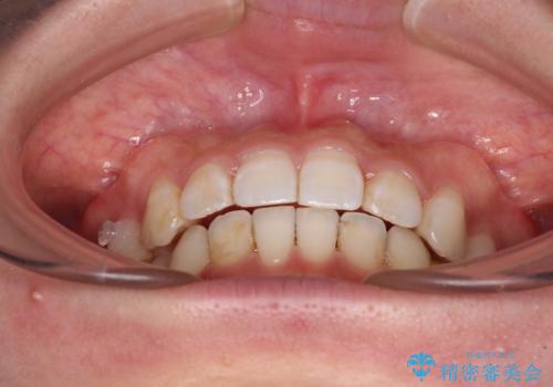 ディープバイトとデコボコを解消 インビザライン矯正の治療中