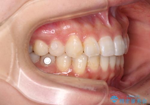 ディープバイトとデコボコを解消 インビザライン矯正の治療中