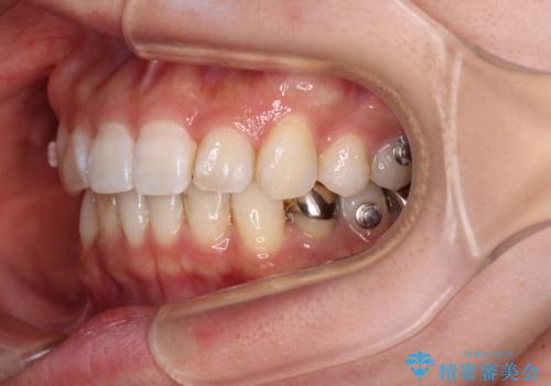 ディープバイトとデコボコを解消 インビザライン矯正の治療中