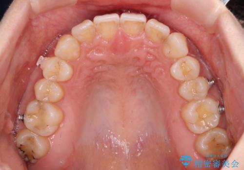ディープバイトとデコボコを解消 インビザライン矯正の治療中