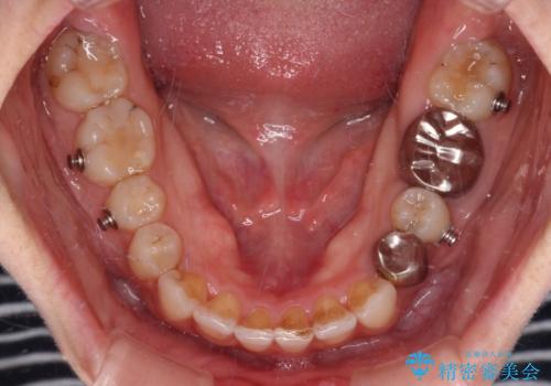 ディープバイトとデコボコを解消 インビザライン矯正の治療中