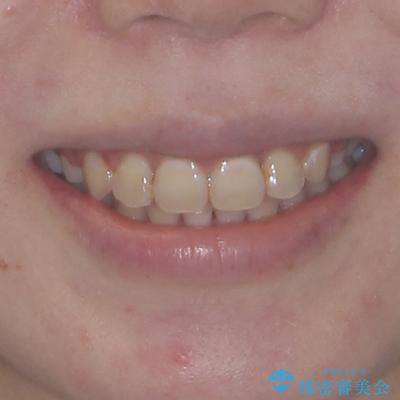 見えないほど重なっている前歯　抜歯矯正でスッキリとした歯並びにの治療後（顔貌）