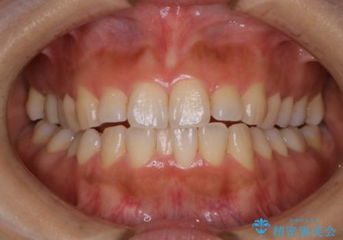 オフィスホワイトニングのエクセレントコースの治療前