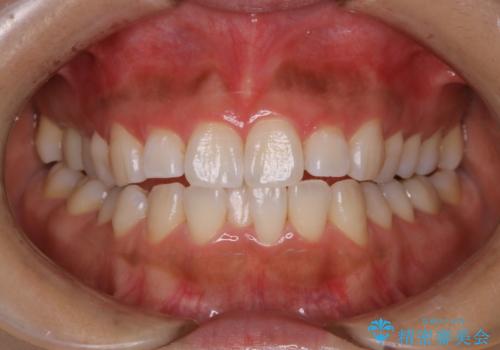 オフィスホワイトニングのエクセレントコースの治療後