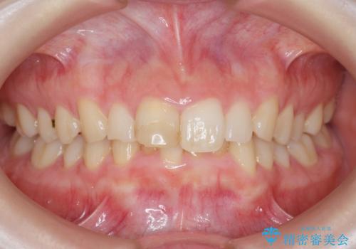前歯のがたつき　深い噛み合わせを改善したいの症例 治療前