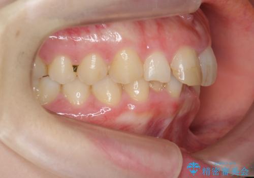 前歯のがたつき　深い噛み合わせを改善したいの治療前