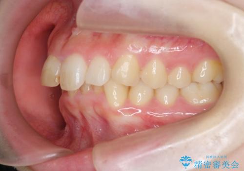 前歯のがたつき 深い噛み合わせを改善したいの治療前