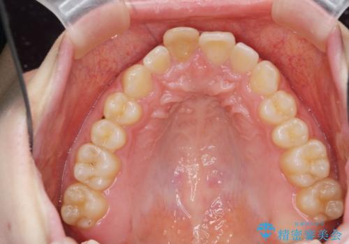 前歯のがたつき 深い噛み合わせを改善したいの治療前