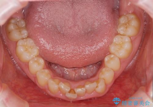 前歯のがたつき 深い噛み合わせを改善したいの治療前